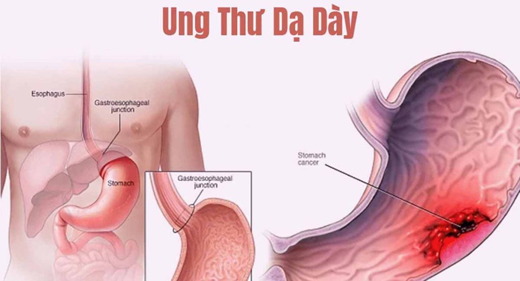 ung-thu-da-day