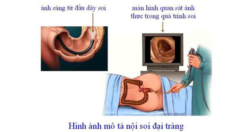 quy-trinh-noi-soi-dai-truc-trang-dien-ra-nhu-the-nao