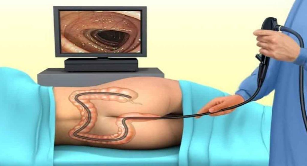 Các tác dụng phụ và rủi ro có thể gặp khi nội soi đại tràng